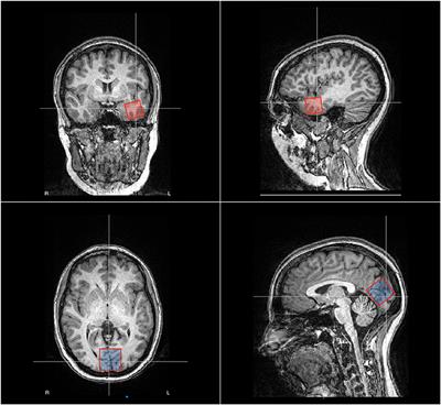 The impact of cathodal tDCS on the GABAergic system in the epileptogenic zone: A multimodal imaging study